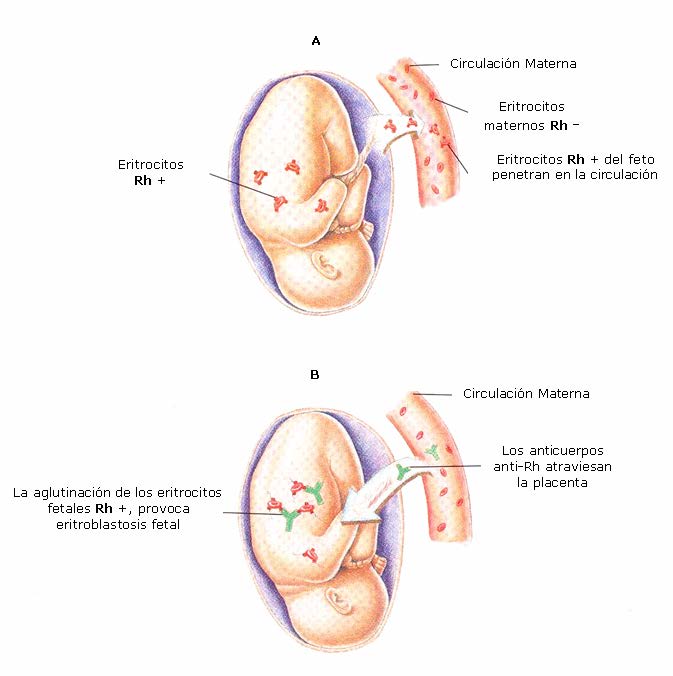 Eritroblastosis Fetal