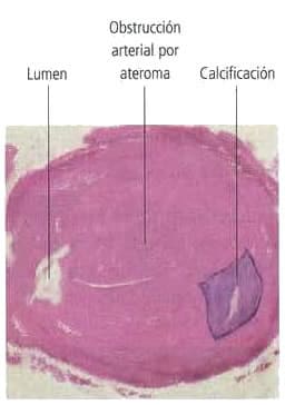 Arteria bloqueada